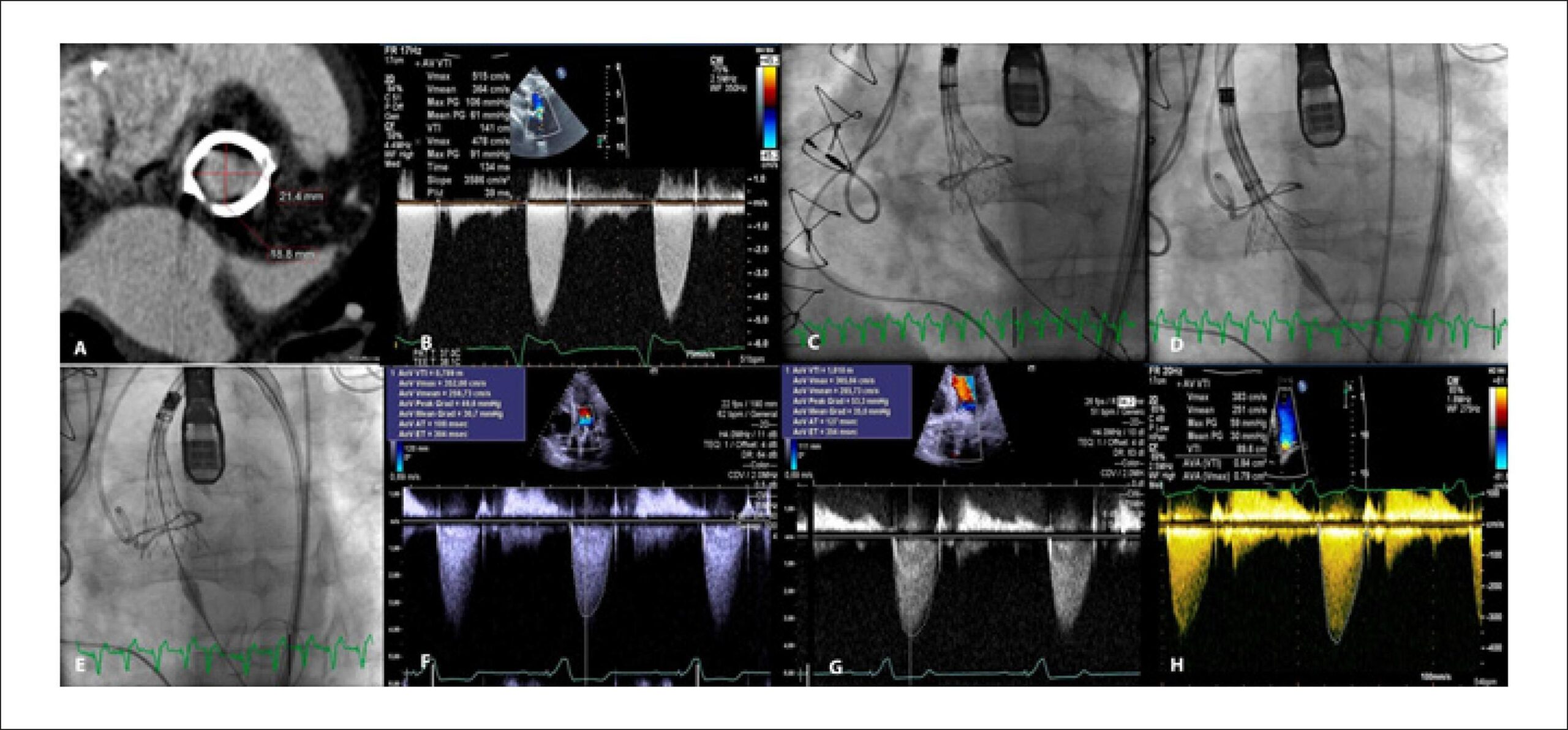Transcatheter Valve-in-Valve Repositioning of CoreValve® Evolut™ Rin Aortic Prosthesis
