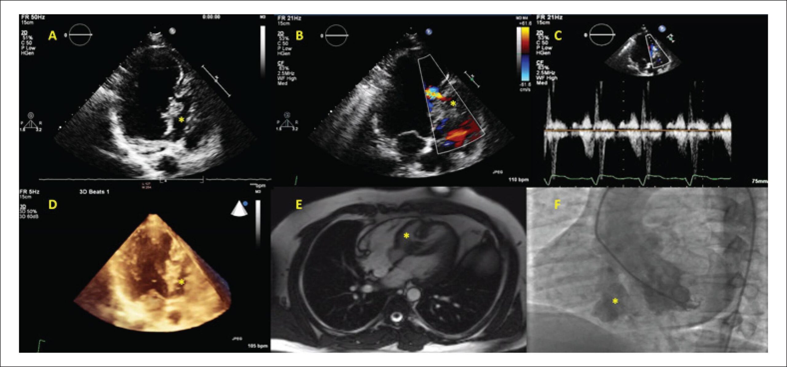 Malformação Congênita Muscular do Septo Interventricular com Características Anatômicas Complexas