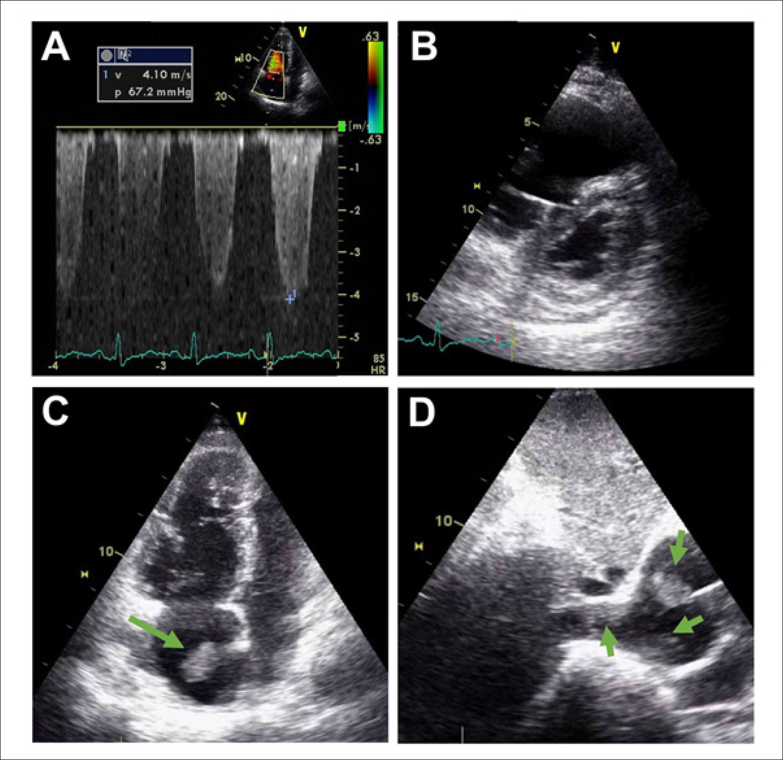 Multiple Thrombi in the Inferior Vena Cava and Right Atrium – Recurrent Thromboembolism Due to Polycythemia Vera