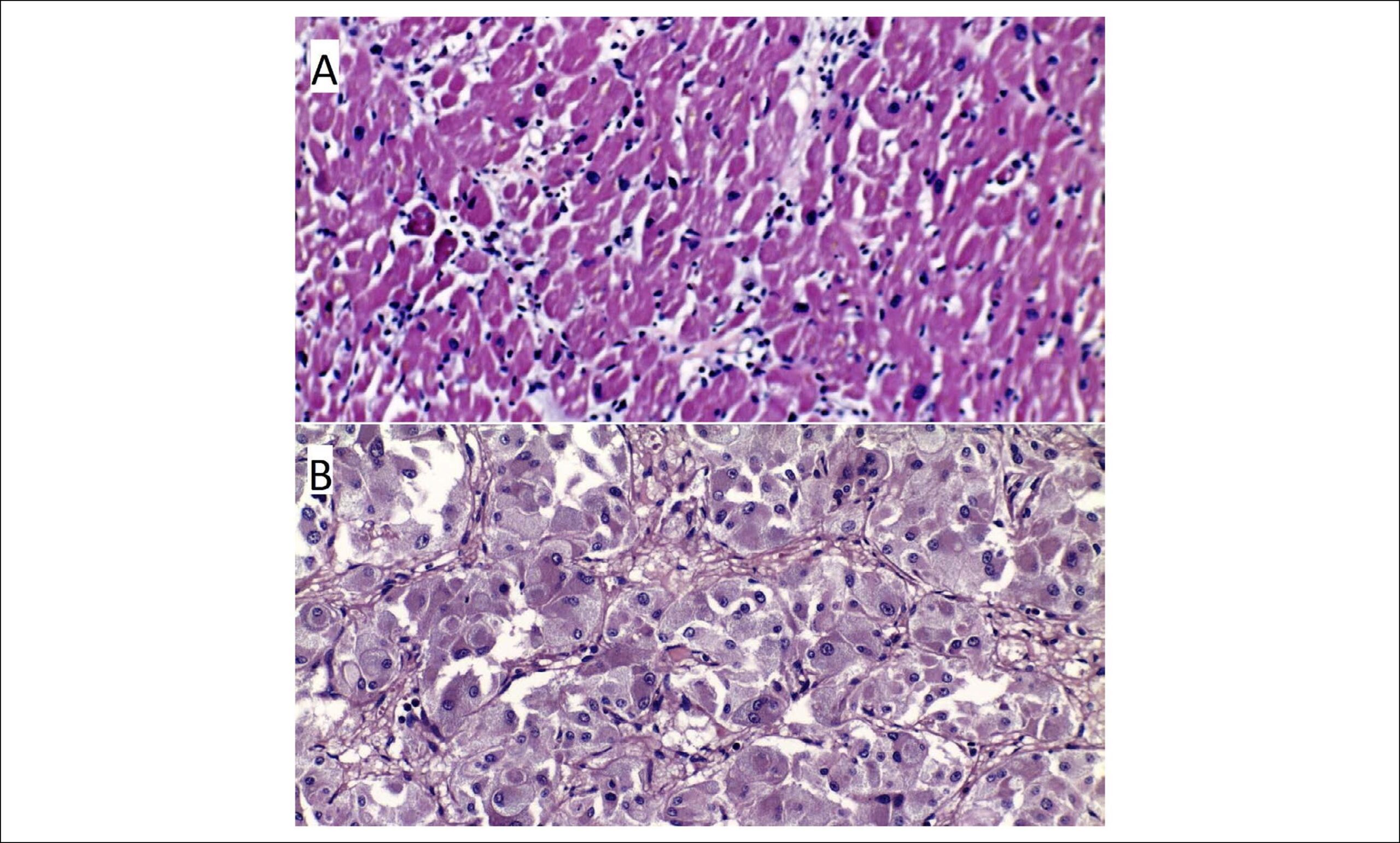Another Cause of Acute Cardiogenic Shock