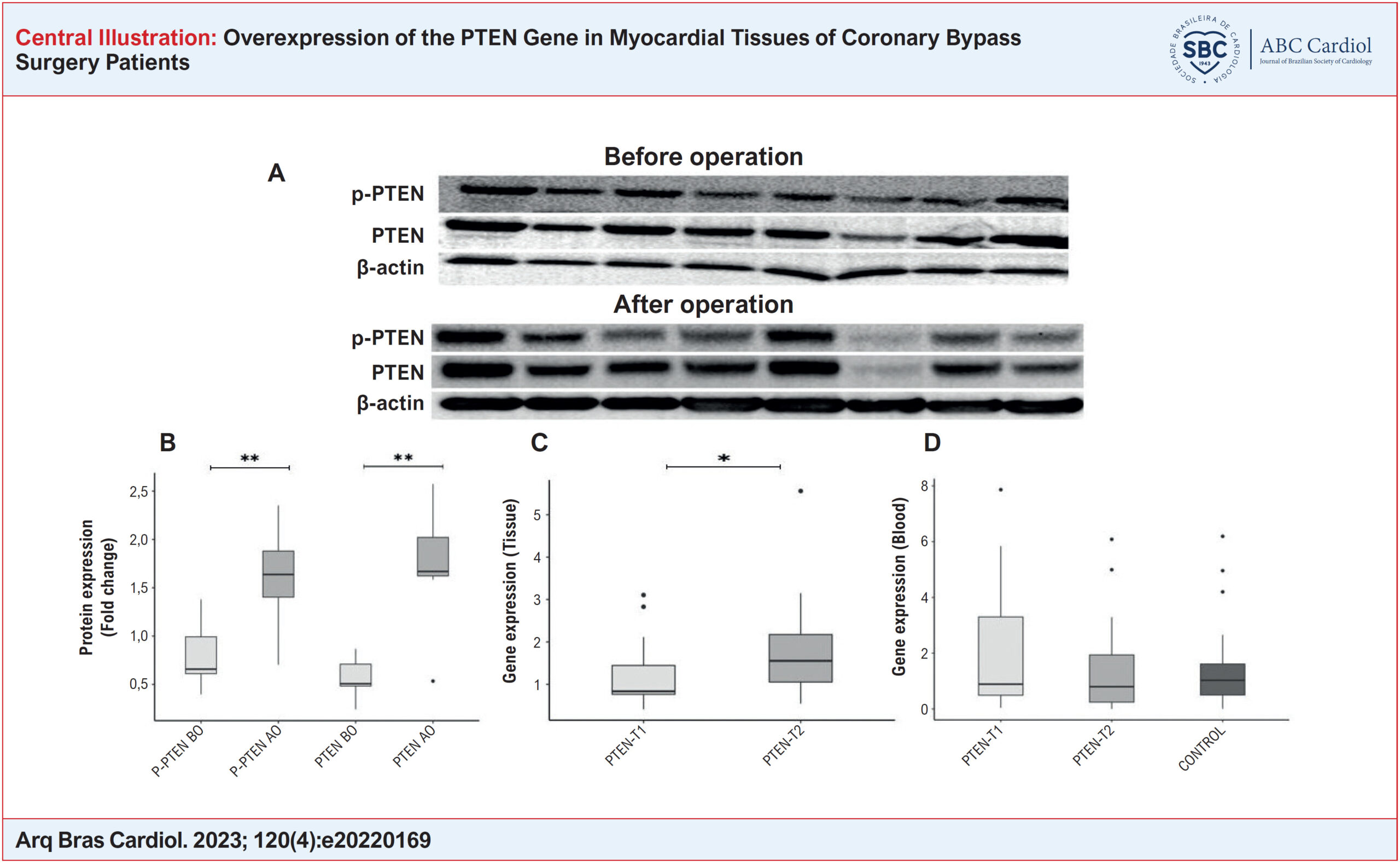 Overexpression of the PTEN Gene in Myocardial Tissues of Coronary Bypass Surgery Patients