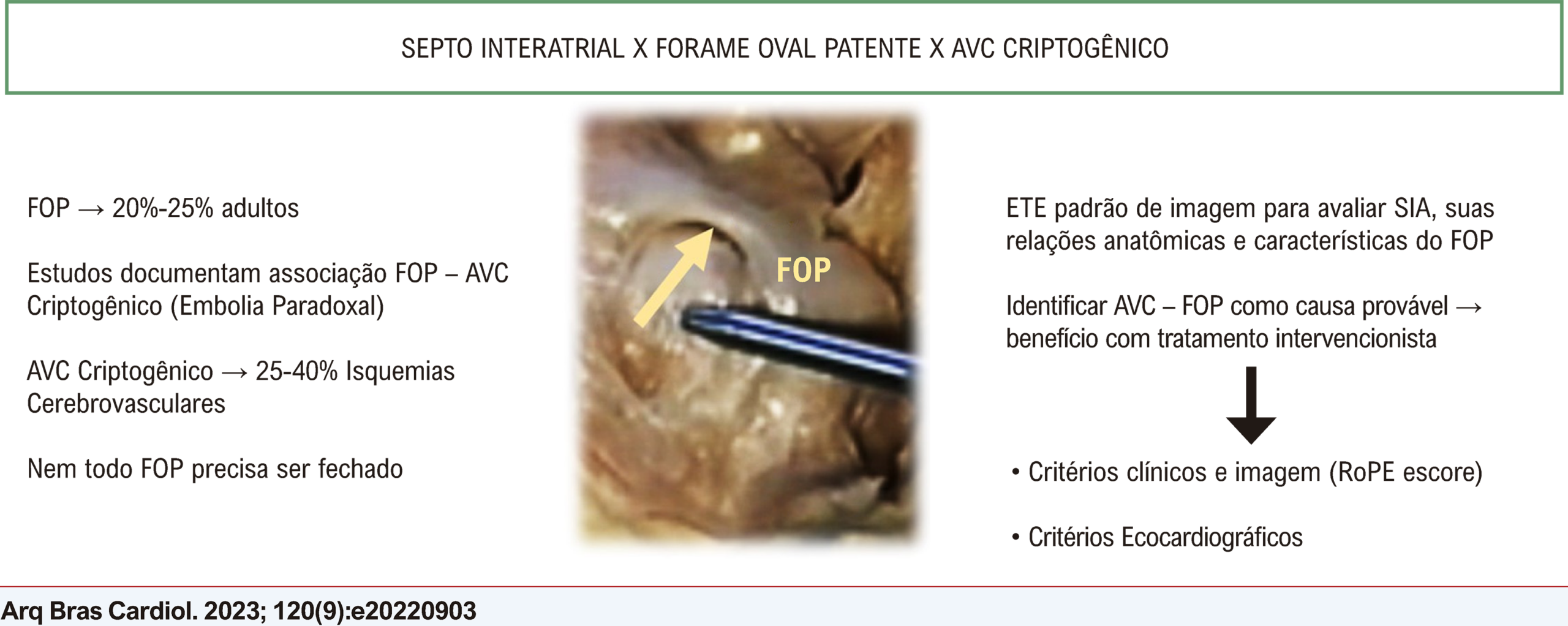 Papel do Ecocardiograma na Avaliação do Septo Interatrial e Pesquisa de Forame Oval Patente como Fonte Emboligênica