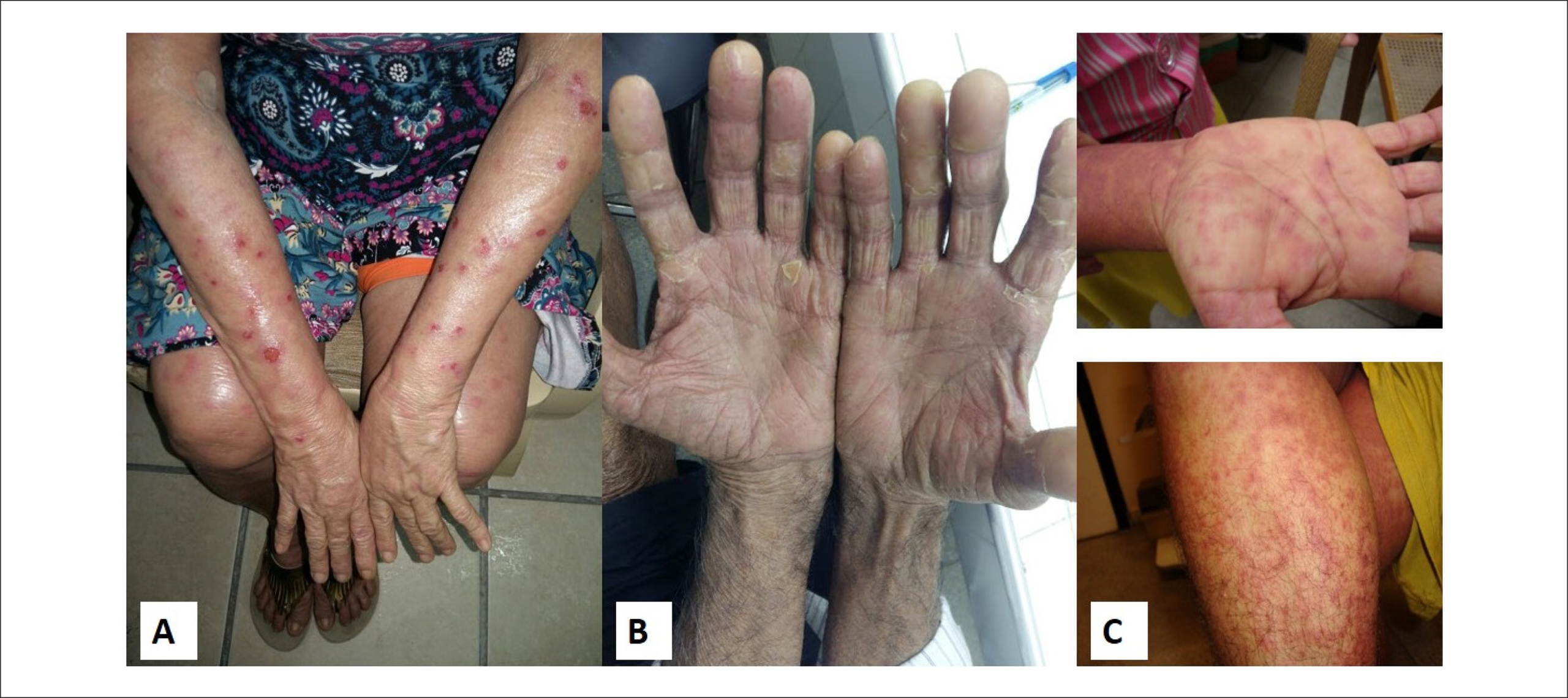 Causalidade e Gravidade das Reações Adversas e Alterações Laboratoriais ao Tratamento com Benznidazol em Pacientes com Doença de Chagas Crônica