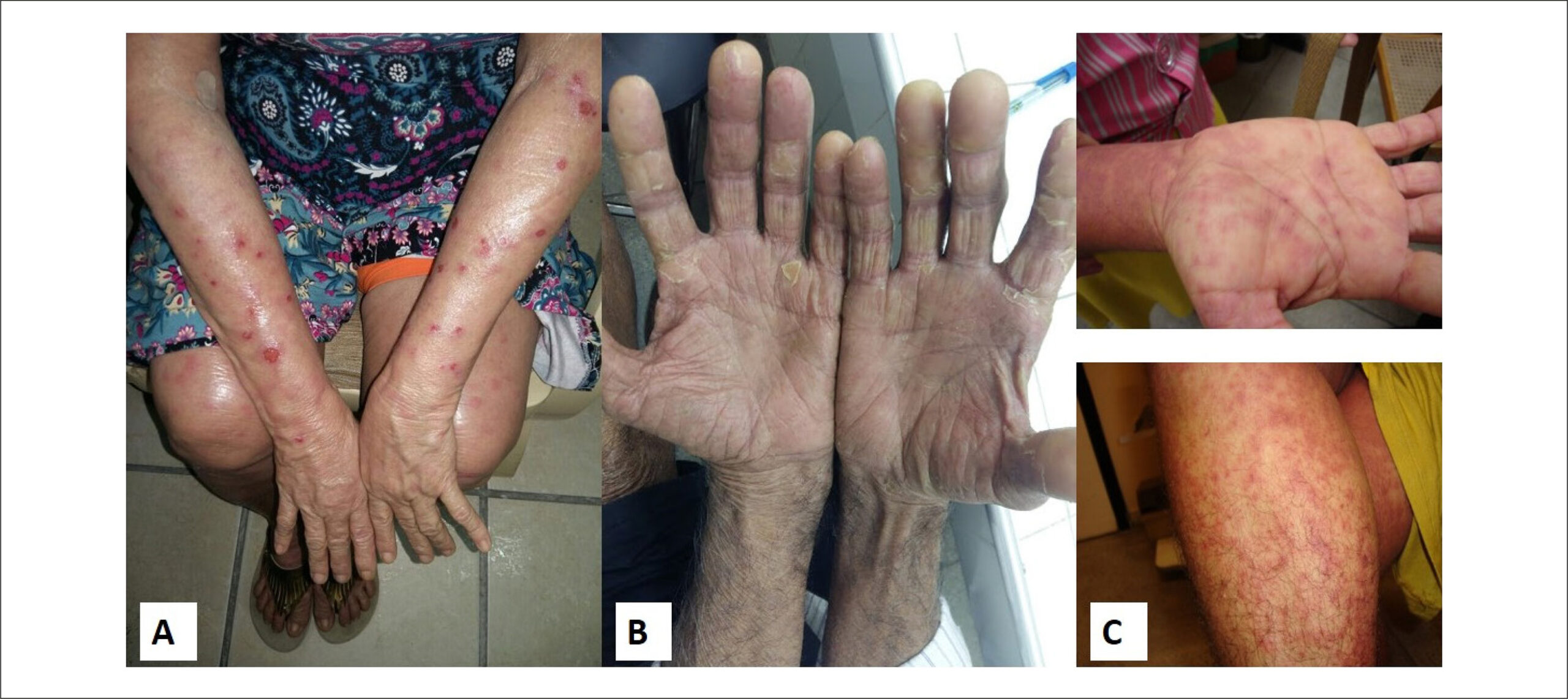 Causality and Severity of Adverse Reactions and Biochemical Changes to Benznidazole Treatment in Patients with Chronic Chagas Disease