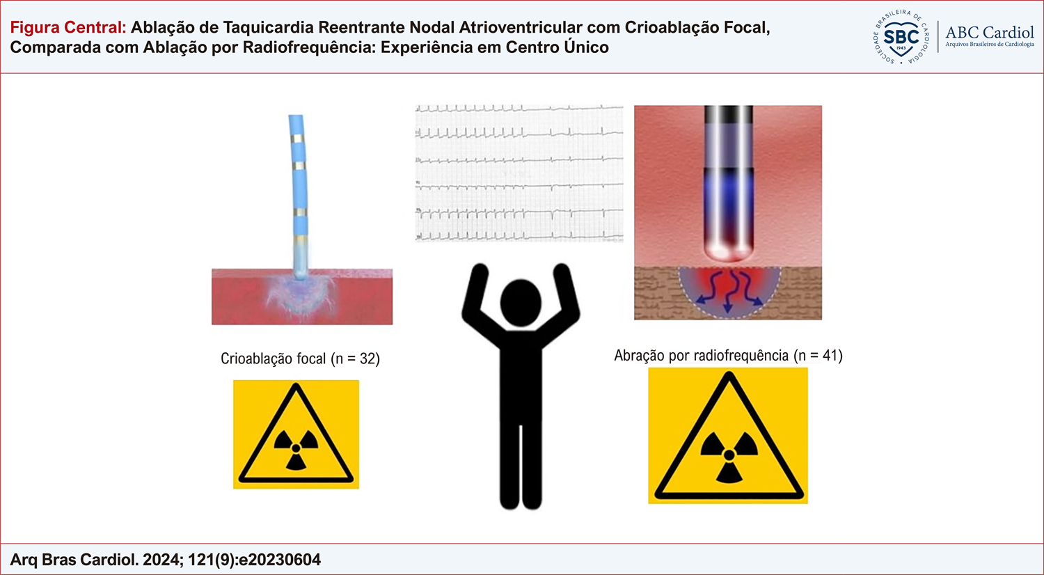 Ablação de Taquicardia Reentrante Nodal Atrioventricular com Crioablação Focal, Comparada com Ablação por Radiofrequência: Experiência em Centro Único