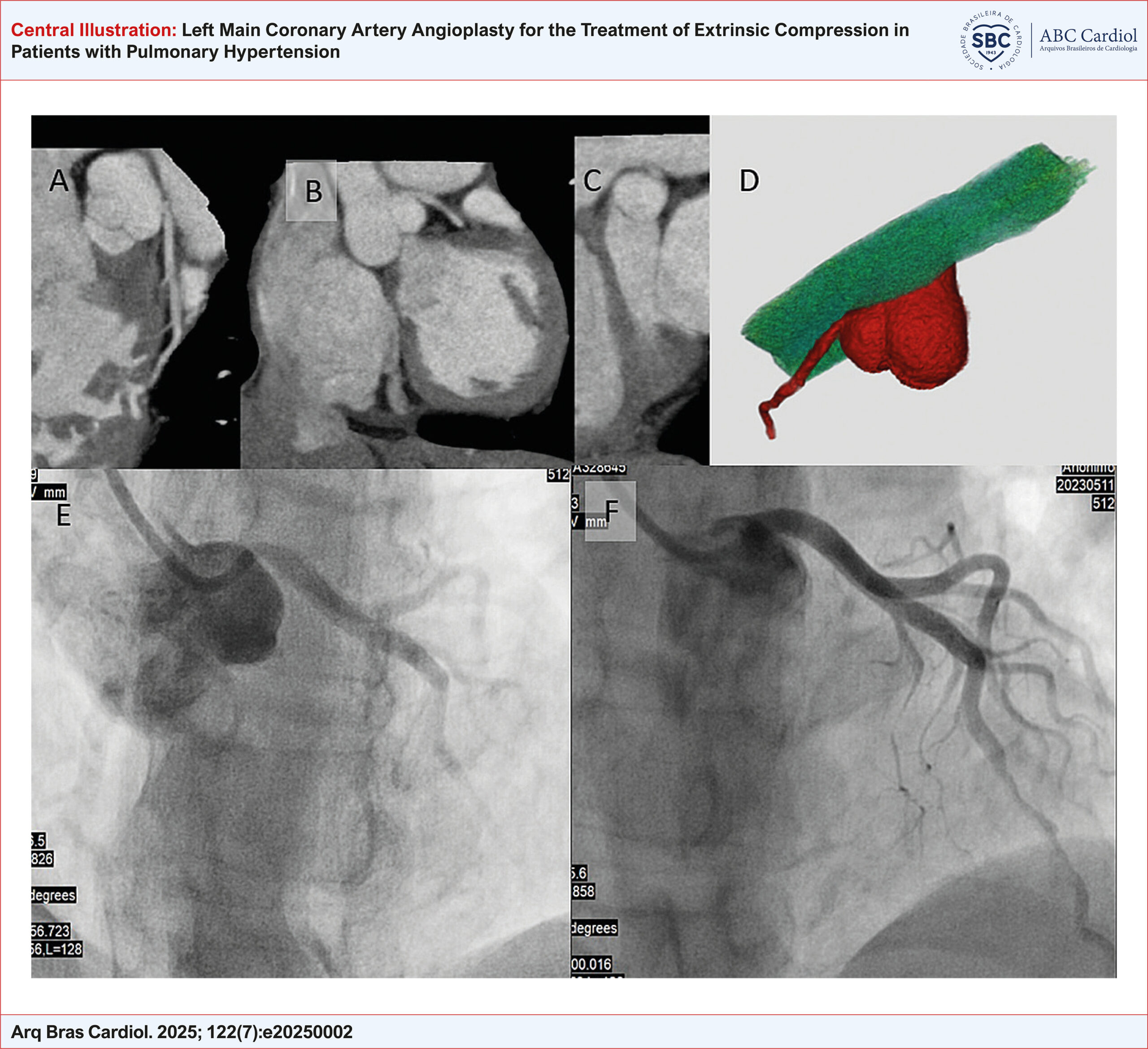 Left Main Coronary Artery Angioplasty for the Treatment of Extrinsic Compression in Patients with Pulmonary Hypertension