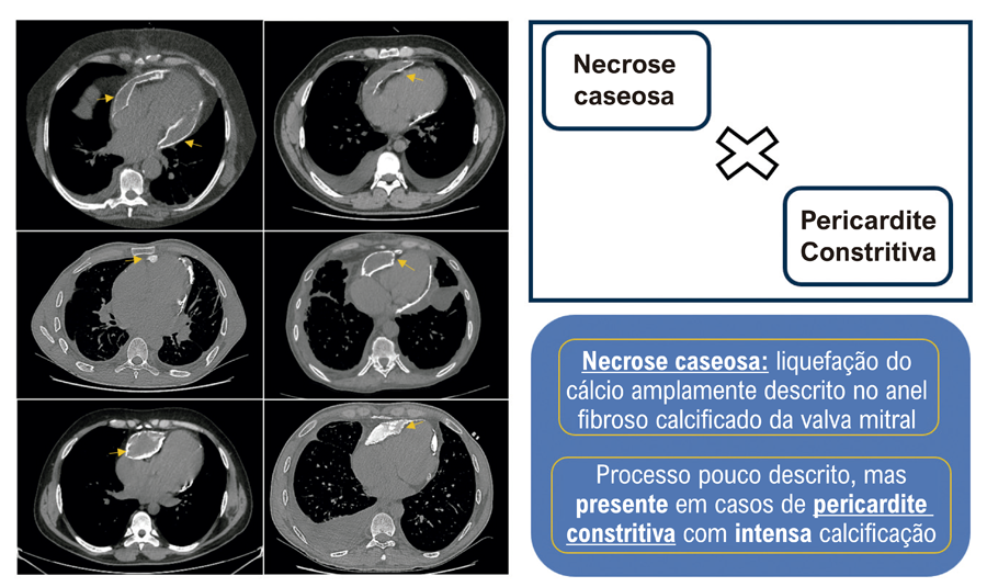 Pericardite Constritiva com Necrose Caseosa: Uma Apresentação Rara e Pouco Conhecida