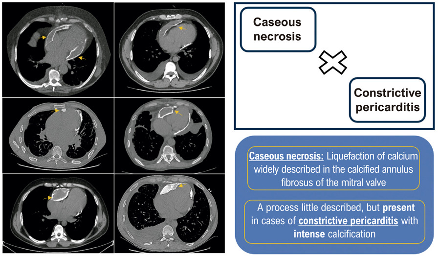 Constrictive Pericarditis with Caseous Necrosis: A Rare and Underrecognized Presentation
