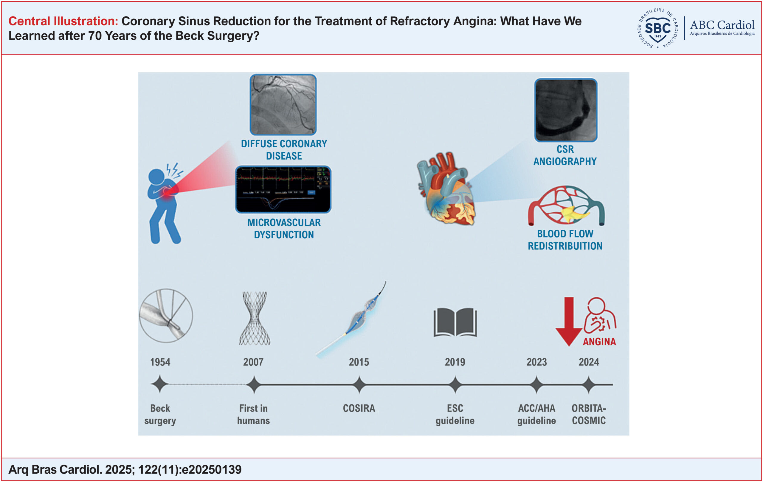 Coronary Sinus Reduction for the Treatment of Refractory Angina: What Have We Learned after 70 Years of the Beck Surgery?