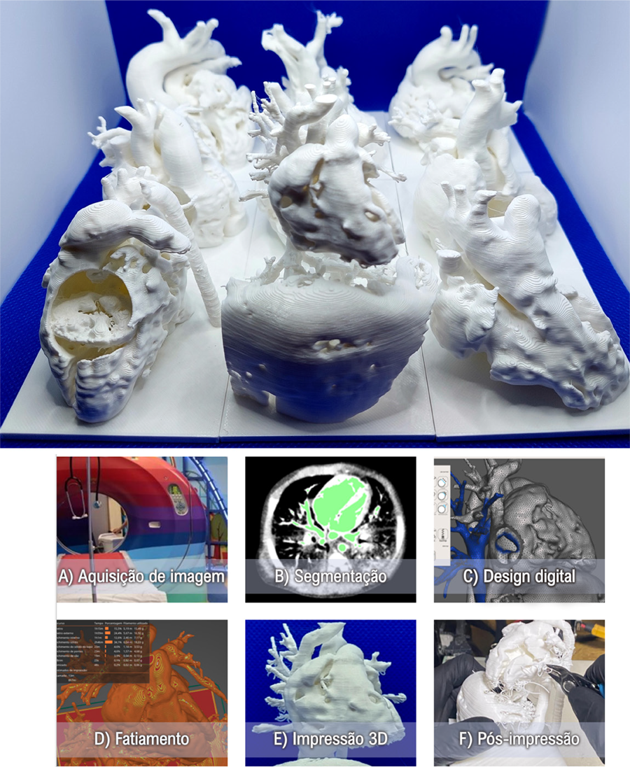 Desenvolvimento de Modelos de Cardiopatias Congênitas em Impressão 3D utilizando Metodologia de Baixo Custo – Uma Potencial Ferramenta para Aprimorar o Ensino da Cardiologia Pediátrica