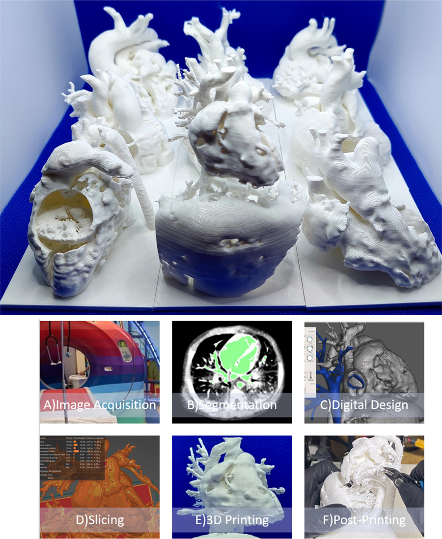 Development of 3D-Printed Congenital Heart Disease Models Using Feasible Low-Cost Workflow – A Potential Tool to Improve Pediatric Cardiology Education