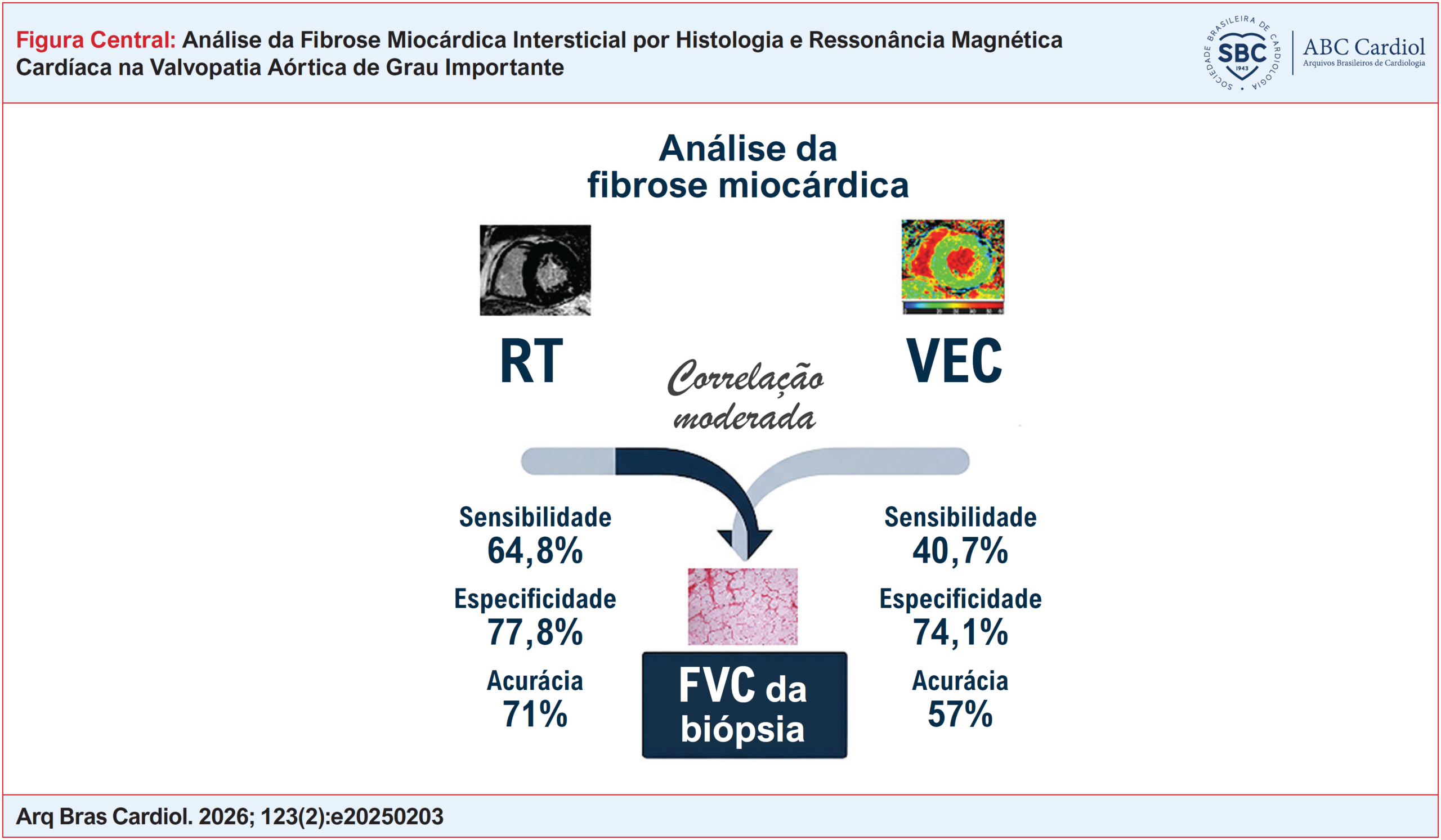 Análise da Fibrose Miocárdica Intersticial por Histologia e Ressonância Magnética Cardíaca na Valvopatia Aórtica de Grau Importante