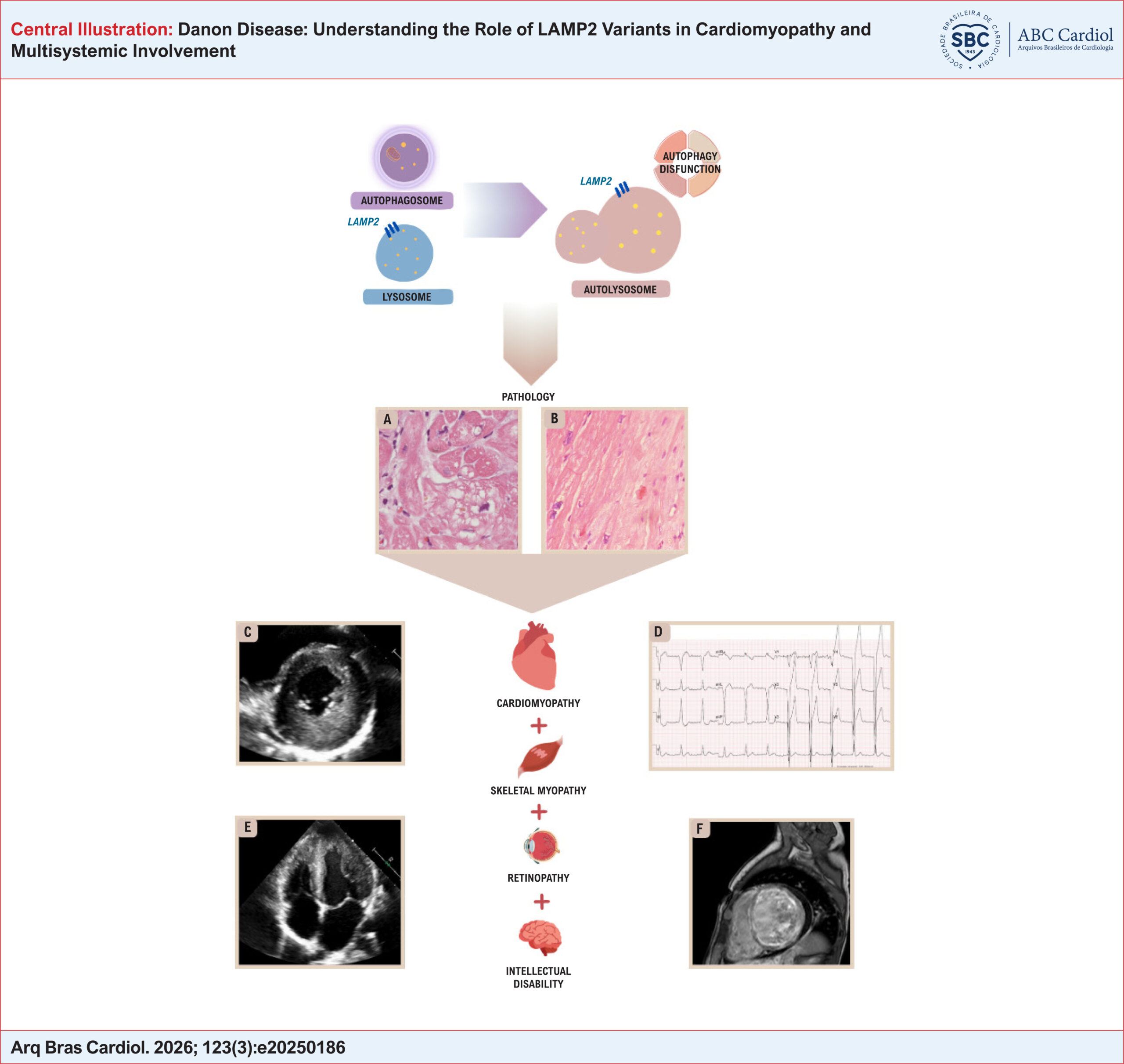 Danon Disease: Understanding the Role of LAMP2 Variants in Cardiomyopathy and Multisystemic Involvement