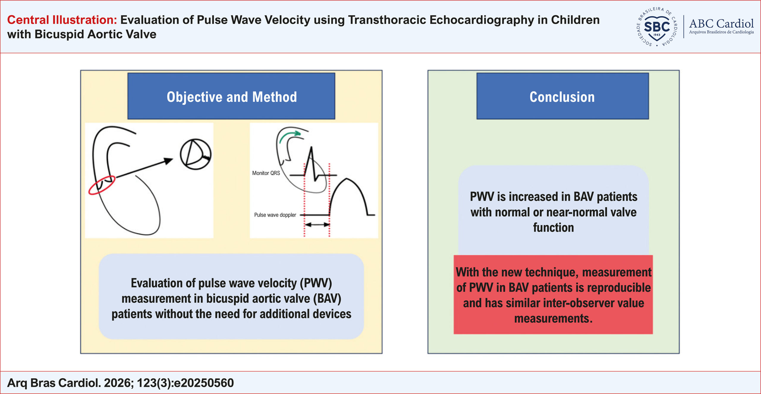 Evaluation of Pulse Wave Velocity using Transthoracic Echocardiography in Children with Bicuspid Aortic Valve
