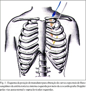 Avaliação da anastomose de artéria torácica interna esquerda com artéria interventricular anterior pela ecodopplercardiografia