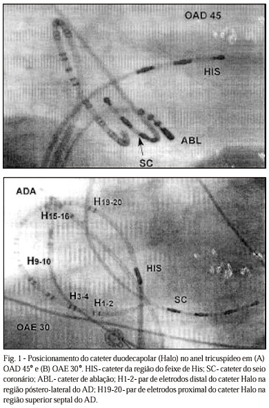 Ablação por cateter do flutter atrial. Caracterização eletrofisiológica da interrupção da condução pelos istmos posterior e septal