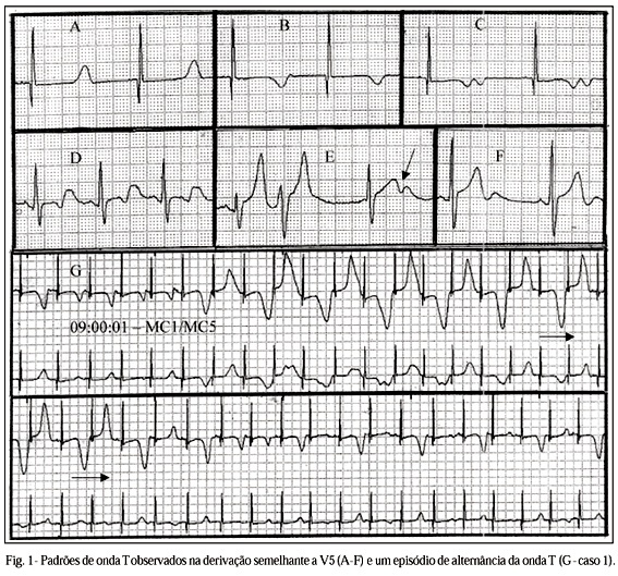 Contribuição de eletrocardiografia dinâmica pelo sistema Holter na avaliação de pacientes com a síndrome congênita do QT longo