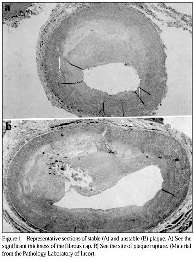 Chronic coronary artery disease
