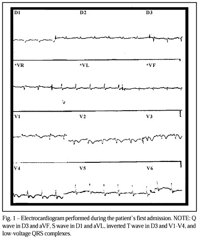 Relapsing pulmonary embolism in a patient with a spinal cord-injure