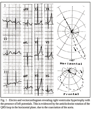Tetralogy of fallot and aortic coarctation. A rare association