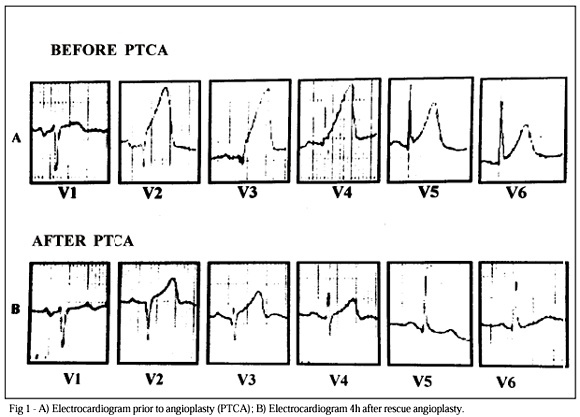 Rescue coronary angioplasty in a patient with acute myocardial infarction and myocardial bridge