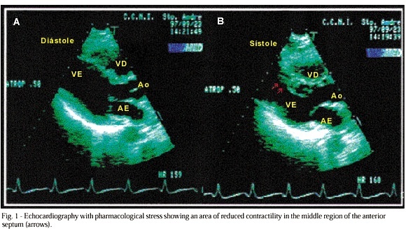 Myocardial bridge in a patient with sickle cell anemia