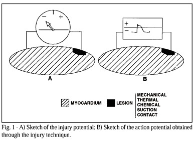 Monophasic action potential. New uses for an old technique
