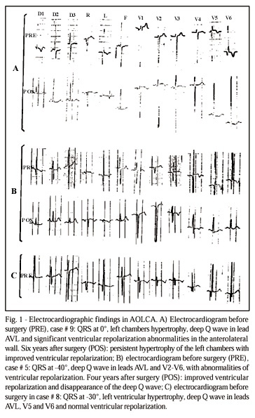 Anomalous origin of the left coronary artery from the pulmonary trunk. Clinical features and midterm results after surgical treatment