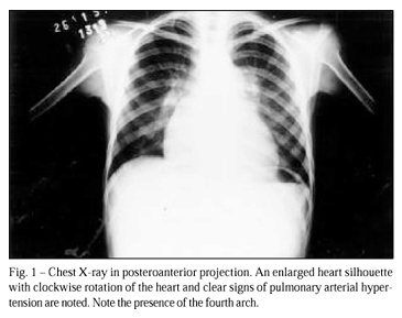 Mitral valve disease with rheumatic appearance in the presence of left ventricular endomyocardial fibrosis