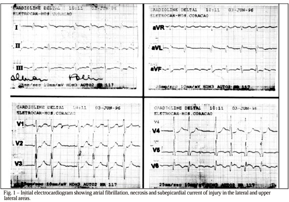 Atrial infarction is a unique and often unrecognized clinical entity