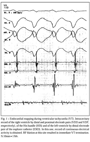 Characteristics and identification of sites of chagasic ventricular tachycardia by endocardial mapping
