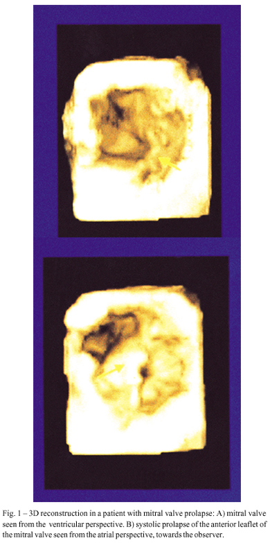 Dynamic three-dimensional reconstruction of the heart by transesophageal echocardiography