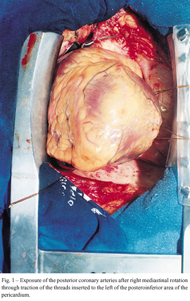 Surgical revascularization of posterior coronary arteries without cardiopulomonary bypass