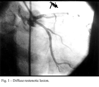 Cutting balloon angioplasty for intrastent restenosis treatment