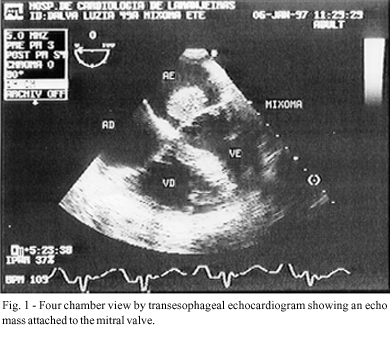 Myxoma of the mitral valve