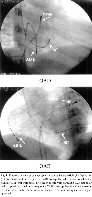 Radiofrequency catheter ablation in patients with atrial fibrillation