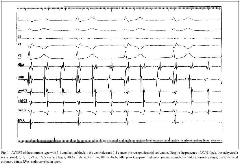 Catheter-induced 3:1 second degree atrioventricular nodal block during atrioventricular nodal reentrant tachycardia
