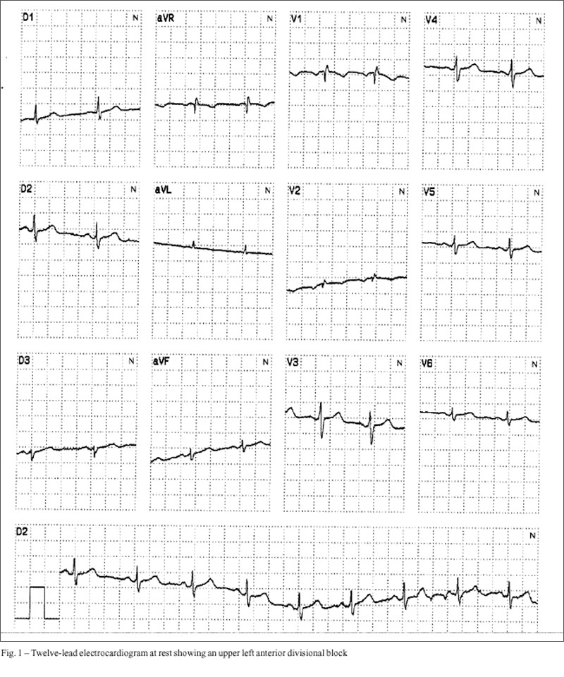 Hypoperfusion of the left ventricle in the absence of changes in segmental contractility as observed through echocardiography by using microbubbles during dobutamine infusion