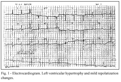 A 45 - year-old woman with hypertrophic cardiomyopathy and cardiogenic shock