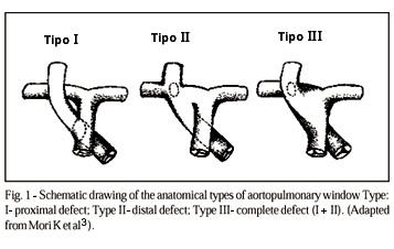 Aortopulmonary window. Clinical and surgical assessment of 18 cases