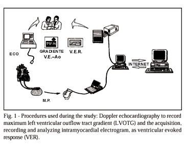 Ventricular evoked response in patients with hypertrophic obstructive cardiomyopathy treated with DDD pacing