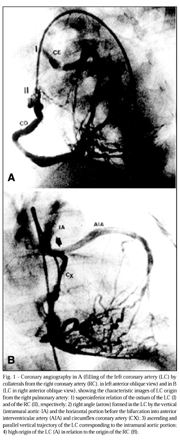 Anomalous origin of the left coronary artery from the right pulmonary artery with intramural aortic trajectory. Clinicosurgical diagnostic implications