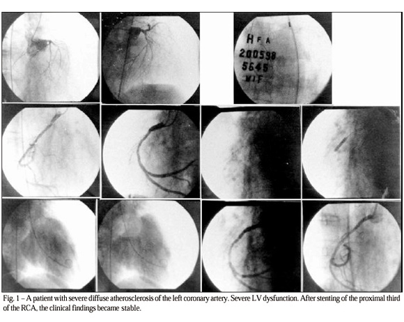 Intraaortic balloon pump support during coronary angioplasty. Initial experience