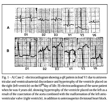 Ebstein's anomaly with coarctation of the aorta. An unusual association