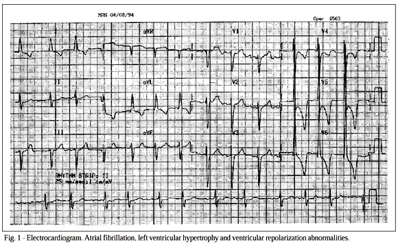 A 63-year-old man with heart failure 3 years after bioprosthetic replacement of mitral and aortic heart valves