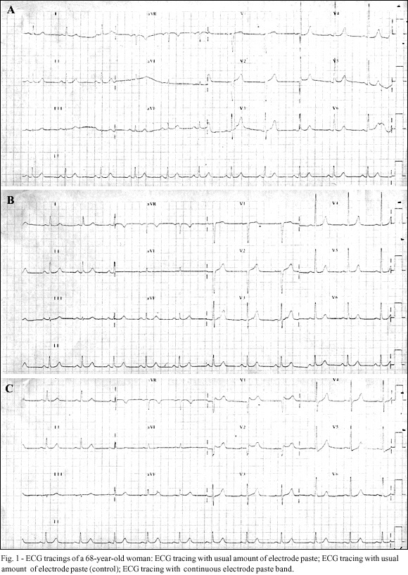Analysis of the effects of the continuous electrode paste band on precordial leads of the electrocardiogram
