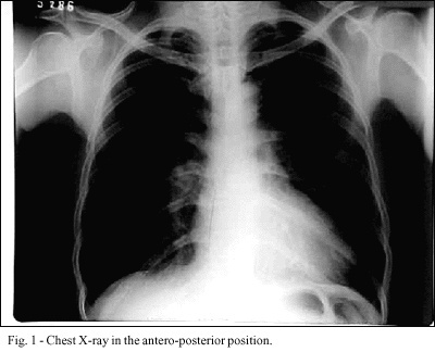 Total agenesis of the left pericardium