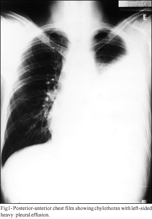 Chylothorax after myocardial revascularization with the left internal thoracic artery