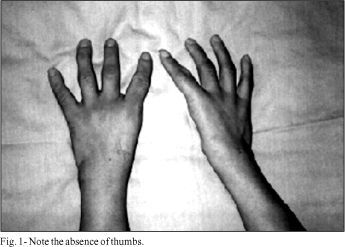 Holt-Oram syndrome revisited. Two patients in the same family