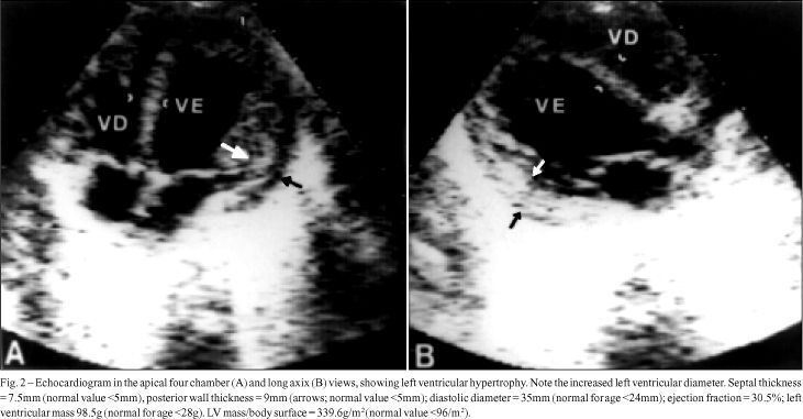 Pompe's disease or type IIa glycogenosis